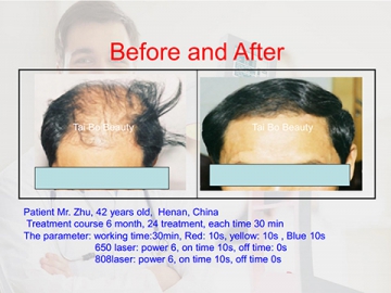 Diode Laser + IR(Infrared) Laser Hair Lose Treatment Machine