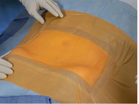 Iodine Incise Film