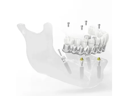 Dental Bridge