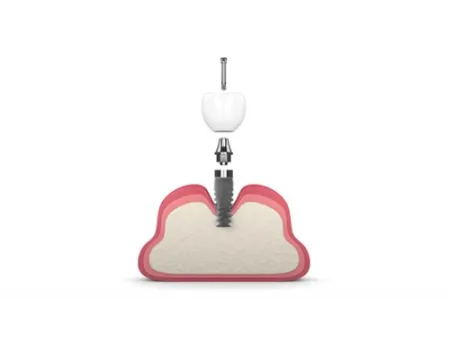 Dental Implant Systems