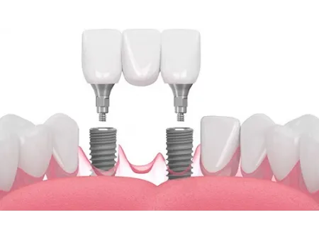 Dental Implant Systems