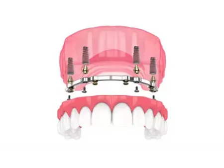 Dental Implant Systems