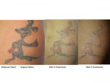 Tattoo Removal