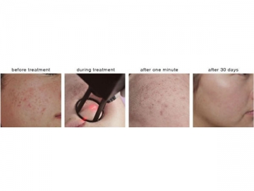 Fractional CO2 Laser (for Skin Resurfacing)